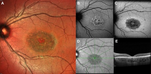 Figure 1 Multimodal imaging of a patient with STGD1 and macular involvement. Color fundus photograph (A), near-infrared-autofluorescence (B) and short wavelength fundus autofluorescence (C). Absence of RPE is visible as an area of irregular hyopoautofluorescence on fundus autofluorescence. Several hyperautofluorescence lesions at the macula correspond to the flecks. The OCT scan (D) centered on the fovea shows atrophy of RPE and ellipsoid zone and backscattering.