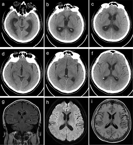 Figure 4 Brain computed tomography and magnetic resonance imaging of patient 4. Brain computed tomography showed hydrocephalus 10 days after clinical onset (a–c). The hydrocephalus significantly relieved after lateral ventricular drainage (d–f). Brain magnetic resonance imaging performed 3.5 months after clinical onset showing no hydrocephalus (g–i).