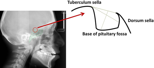 Figure 2 Normal sella turcica morphology and reference lines used for measuring sella size.