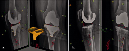 Figure 1. RSA images showing the biplanar (lateral and anteroposterior) views with the polyethylene markers and tibial bone markers encircled in red, the fiducial markers in yellow, and the control markers in green. (a) Only 3 of 5 polyethylene markers are visible due to over-projection of 2 markers, in most cases, by the femoral component, which may reduce or invalidate the marker-based accuracy of the RSA measurement. However, migration can also be measured by fitting a model using the contours of the metal-backed tibial component as shown in orange. (b) Migration of the radiolucent all-polyethylene tibial component can only be measured with marker-based RSA.