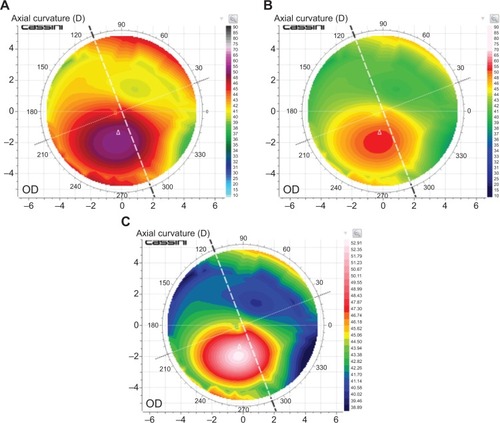 Figure 2 Axial curvature maps.