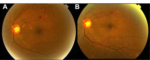 Figure 4 Fundus photograph of the left eye showing (A) focal macular edema in the superotemporal quadrant and (B) a decrease in exudates at the 12-month follow-up. (Patient treated with one session of micropulse diode laser photocoagulation.)