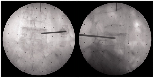 Figure 9. Verifying the accuracy of pedicle screw placement using the AP and lateral fluoroscopic images.