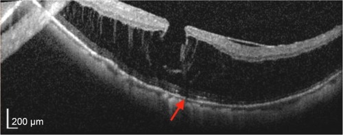 Figure 4 Myopic foveoschisis showing disruption of ISel band (red arrow) and ELM.