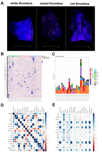Figure 1 (A) Immunofluorescence images of white thrombosis, mixed thrombosis and red thrombosis with CD45-labeled immune cells (red) and SYTO13-labeled nuclei (blue). Regions of interest (ROI) were selected based on morphological marker antibodies. (B) Heat map of expression matrix of whole gene assay results in all regions of interest (ROI). (C) Abundance map of immune/inflammation cell subsets for each ROI. (D) Correlation matrix plot of the abundance of immune/inflammation cell subsets in white, mixed and red thrombosis. (E) Heat map of correlation between immune/inflammation cell abundance and gene expression. *p<0.05; **p<0.01; ***p<0.001.