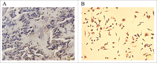 Figure 7. Analysis of SKA1 expression in human osteosarcoma specimens. (A) Weak positive staining of SKA1 in human osteosarcoma. Magnification, ×400. (B) SKA1 staining in positive control, A549 cells. Magnification, ×200.