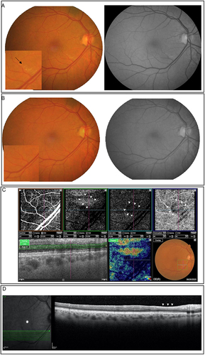 Figure 1 Main retinal findings and OCT follow-up patient 1 (A–C). (A) Colour fundus photography and red-free 30-days after symptoms imaging of the right eye of a female patient in her 60s revealing well-delimited sectorial pallor at the lower temporal arcade (black arrow). Vasoactive pharmacological support was not necessary during hospitalisation. (B) Colour fundus photography and red-free 70-days with disappearance of the lesion. (C) OCT-A 30-day follow-up shows a triangular area of low blood flow (white arrowhead), corresponding to the region of retinal pallor. (D) OCT B-scan in the 70-day follow-up of the retinal pallor. Note the local retinal thinning, with loss of differentiation of the inner layers of the retina (white arrowhead).