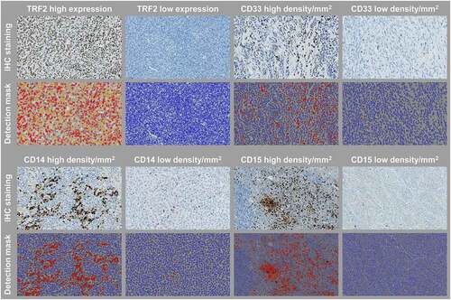 Figure 1. Representative images of immune biomarkers and TRF2 staining, and their cell detection mask overlays used in the digital image analysis. Original magnification, x 200