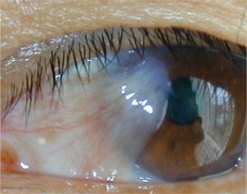 Figure 4 Typical fibrovascular nasal pterygium amenable to a superior and inferior rotational conjunctival graft procedure.