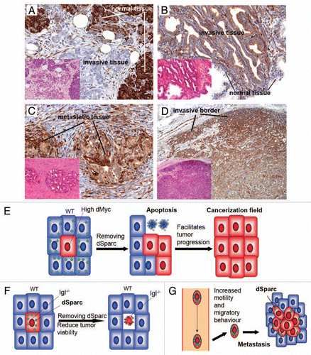 Figure 1 Similarities in the role of Sparc between cell competition and human cancers. (A–D), Serial tissue sections were stained with H&E (small parts) and with immunohistochemistry for SPARC (brown). (A) represents pancreatic ductal adenocarcinoma showing decreased SPARC compared with the surrounding normal parenchima of the pancreas. (B) the opposite pattern of SPARC expression is evident: prostatic acinar adenocarcinoma is characterized by increased expression of SPARC and the surrounding normal glands have barely detectable levels. (C) Metastasis, to spermatic cord, of prostatic acinar adenocarcinoma shows even higher levels of SPARC. (D) cells located at the invasive borders of meningiomas are characterized by strong expression of SPARC, when compared to the remaining tumor cells. Original magnification for (A–C), ×200; for (D), ×100. (E) In a first type of tumors, supercompetitors expand by killing normal surrounding cells that in the absence of SPARC cannot defend themselves. This type of tumors may form cancerization fields. (F) A second type of tumors (lethal-giant-larvae like) may have fitness problems and activate SPARC that allows them to survive. (G) Metastatic cells may survive better in soil tissues protecting themselves from a foreign environment upregulating SPARC.