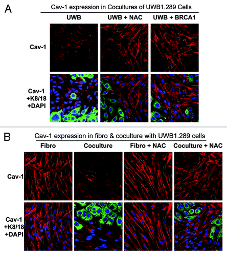 Figure 11. Cav-1 expression is downregulated in stromal fibroblasts co-cultured with BRCA1-null ovarian cancer cells: Rescue with NAC or wild-type BRCA1. (A and B) UWB1.289 cells and UWB1.289+BRCA1 cells were cultured with BJ-1 fibroblasts for 5 d. Then, 10 mM NAC or vehicle alone was added every 24 h for 48 h. Cells were then fixed and immunostained with anti-Cav-1 (red) and anti-K8–18 (green) antibodies. Cav-1 staining (red) is shown in the top panels, with MCT4, keratin and DAPI (as a nuclear counter-stain) shown in the bottom panels. Original magnification, 40x. Note that Cav-1 is downregulated in fibroblasts co-cultured with UWB1.289 cells and that Cav-1 expression in fibroblasts is rescued by the addition of NAC or the BRCA1 wild-type gene in UWB1.289 cells (A). Also, note that NAC does not exert any effects on Cav-1 expression in fibroblasts under homo-typic culture conditions (B).