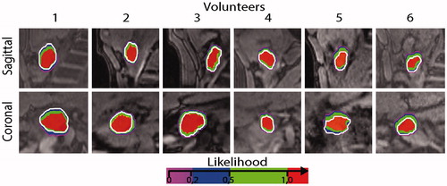 Figure 4. Likelihood P(x,y,z) overlay in Ω on the reference image in all our volunteer. A single slice through the coronal and sagittal orientations are represented for all volunteers, while the contour of the target in the reference phase is represented with a white contour.