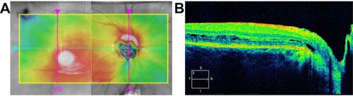 Figure 3 Twelve weeks after vitrectomy and C3F8 tamponade. (A) OCT topographic image showing inferonasal retraction of maculoschisis fluid out of the fovea. (B) OCT cross-section showing sustained closure of the pit-macula communication and resolved foveal schisis (5/27/15, CMT 410 microns, Volume 13.3 mm3).Abbreviations: OCT, optical coherence tomography; CMT, central macular thickness.