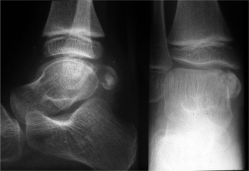 Figure 1. Lateral and anteroposterior radiograph of the right ankle showing an irregular calcified mass on the posterior side of the talus.