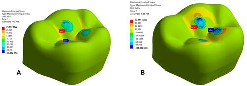 Figure 9 The maximum tensile stress for B groups of lithium disilicate studied under axial compressive load (A) 50 N; (B) 150 N.