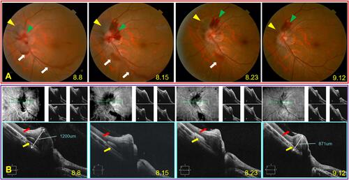 Figure 2 Follow-up of Case 1 for 5 weeks without any treatment. (A) Significantly subsided hemorrhage after the transient bleeding increases. (B) Persistent posterior vitreous body detachment sparing the nasal margin of the optic disc (red arrow), reduced height of the elevated optic disc (white double arrow), and the gradually disappearing subretinal hemorrhage (yellow arrows).