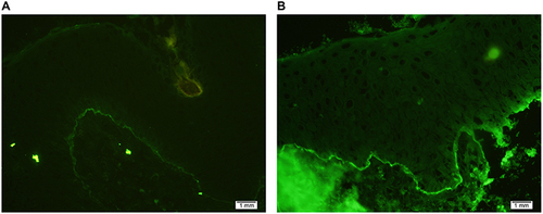 Figure 3 Direct immunofluorescence of the skin specimen shows a linear deposition of complement C3 and immunoglobulin G along the dermo-epidermal junction (A and B).