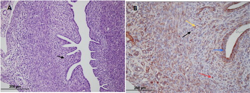 Figure 1. Control group; (A) Endometrium, endometrial stromal cell (black arrow) (hematoxylin-eosin × 200) (B) Endometrial stromal cell (black arrow); VEGFR-2 immunostained endothelial cell (yellow arrow); VEGFR-2 immunostained epithelial cell (blue arrow); VEGFR-2 immunostained microvessel (red arrow) (× 200).