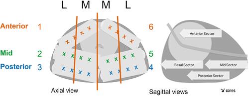 Figure 2 Ginsburg Protocol template. Adapted from Eur Urol, Hansen N, Patruno G, Wadhwa K, et al. Magnetic Resonance and Ultrasound Image Fusion supported transperineal prostate biopsy using the ginsburg protocol: technique, learning points, and biopsy results. 332–340, Copyright (2016), with permission from Elsevier.Citation19