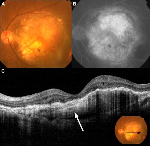 Figure 5 Fundus photography, FA and OCT 36 months after the first Ironing PDT performed in patient 7.