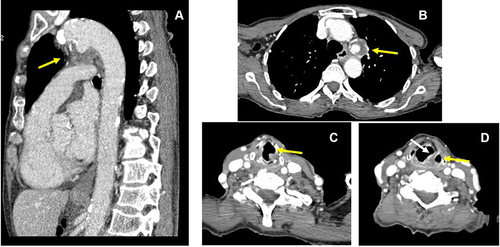 Figure 1 Ductus bump aneurysm. (A and B) Sagittal reformatted (A) and axial (B) postcontrast CT images of the chest show a ductus bump aneurysm, partly thrombosed (yellow arrows). (C and D) axial postcontrast CT images of the neck show findings compatible with left vocal cord palsy: enlargement of left ventricle (C, yellow arrow) and pyriform sinus (D, yellow arrow), medial rotation and thickening of the left aryepiglottic fold (D, white arrow).