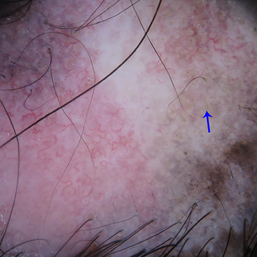 Figure 6 Trichoscopy of scalp discoid lupus erythematosus shows yellow follicular plugs (blue arrow), perifollicular and interfollicular blue-gray dots, and arborizing vessels. Note the hair diameter variability at the lower part of the image.