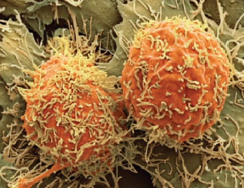 Figure 1 A colored scanning electron micrograph of two hepatocellular carcinoma cells (Steve Gschmeissner/SPL).Notes: Patients with the disease typically live for only 6 to 20 months after diagnosis. Reproduced with permission from Scudellari M. Drug development: try and try again. Nature. 2014;516(7529):S4–S6.