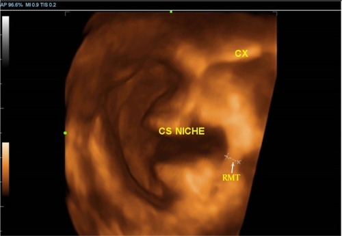Figure 4 RMT assessment by 3D ultrasound in cervical dilatation group.
