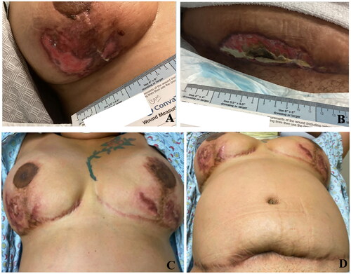 Figure 3. A: Right breast following 3 months of treatment. B: Abdomen after 3 months of treatment. Complete healing with cribriform scar after 8 months of treatment. C: Right and left breast after 8 months of treatment. D: Abdomen after 8 months of treatment.