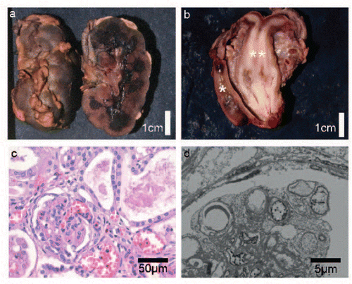 Figure 3. Histological, macroscopic, and electron microscopy observations from postmortem examination. a: Enlarged hyperlobulated kidney with macroscopically small cystic change at the corticomedullar transition zone. b: Uterus didelphys (**) with duplicated cervix and a single vagina. Normal development of rectum (*). c: Histology of the kidneys with glomeruli showing diffuse mesangial sclerosis and hypercellularity. There is marked interstitial fibrosis and tubular atrophy with formation of microcystic tubule dilatations and a lymphocytic inflammation (H.E. staining). d: Electron microscopy of the kidney shows extensive effacement of podocytes with fatty vacuoles.