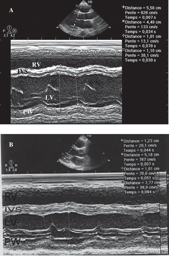 Fig. 4. Echocardiographically parasternal long axis depicted improvement of ventricle function in the second case. A) Echocardiogram obtained on the second day after admission depicts global hypokinesis with LVEF of 30% (calculated by Simpson method) and dilatation of LV. B) Echocardiogram taken eight days after admission showed improvement of ventricle function LVEF of 30%. RV: right ventricle; IVS: interventricular septum; LV: left ventricle; PW: posterior wall.