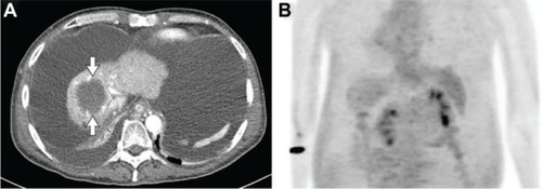 Figure 3 Computed tomography scan before orthotopic liver transplantation demonstrated a decrease of the primary tumor to 6.4 cm with a large amount of ascites (A). A remarkable decrease in fluorodeoxyglucose uptake in the primary tumor was identified without visible distant metastasis on positron emission tomography and computed tomography (B).