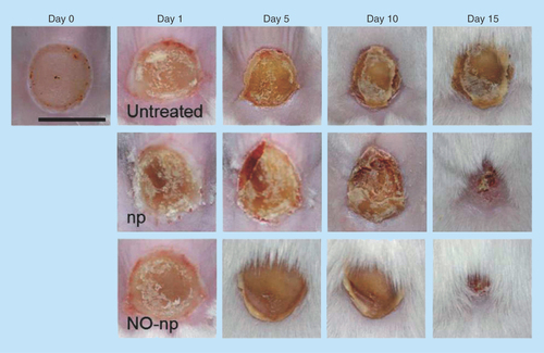 Figure 3.  Burn wounds infected with Candida albicans: untreated, treated with empty nanoparticles, and treated with nitric oxide nanoparticles, at days 0, 1, 5, 10 and 15.Scale bar: 5 mm.NO: Nitric oxide; np: Nanoparticle.Reproduced with permission from [Citation48]. © Macherla C, Sanchez DA, Ahmadi MS et al. (2012).