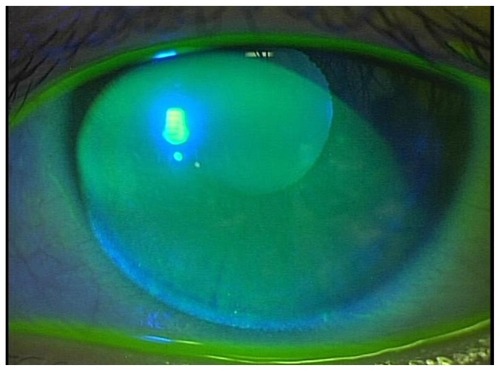 Figure 3 Four weeks after topical administration of rebamipide, the corneal erosion was completely resolved and the tears were clear without any debris or other evidence of inflammation.