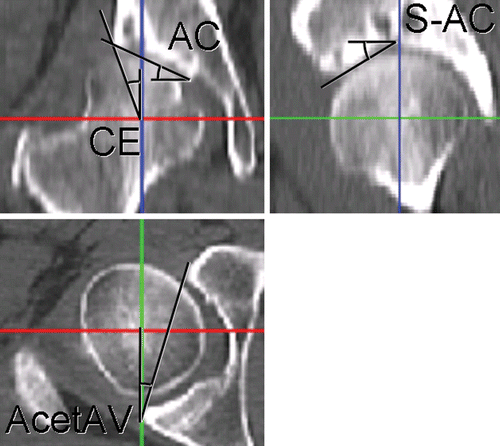 Figure 1. All angles were measured from the three reformatted CT slices (coronal, sagittal, and transverse) passing through the center of the femoral head on the ipsilateral side. In the coronal view, the CE angle and the AC angle were measured. The CE angle is defined by the most lateral aspect of the acetabular rim, the center of the femoral head, and a point vertical (superior) to the center point. The AC angle measures the obliqueness of the acetabular roof based on the most lateral and the most medial aspects of the sourcil, and a horizontal (lateral) line. The S-AC angle and the AcetAV are measured from image reformats in the sagittal and transverse planes, respectively. In the sagittal plane, the most anterior portion of the acetabular rim, the top of the acetabular roof, and a horizontal line make the S-AC angle. The acute AcetAV angle is measured by a line parallel to the acetabular opening and one perpendicular to the centers of the femoral heads on the transverse plane. [Color version available online.]