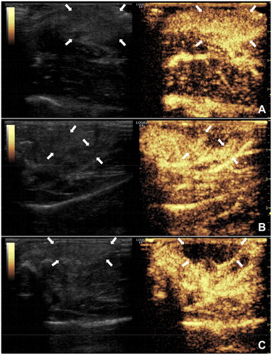 Figure 6. CEUS for monitoring and evaluating the effectiveness of synovial ablation; A: preoperative CEUS showing highly hyperplastic synovium (↑); B: CEUS monitoring during ablation showing residual synovium (↑); C: CEUS after re-ablation showing no residual synovium (↑).