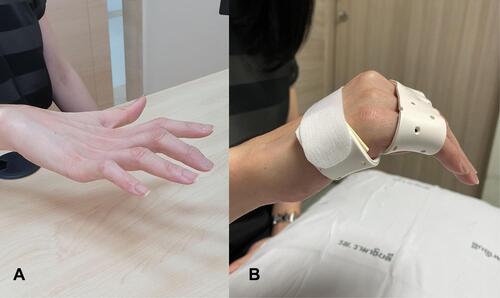 Figure 5 Right claw hand deformity (metacarpophalangeal (MCP) joint hyperextension and interphalangeal (IP) joint slightly flexion) in resting position (A) and after wearing a static figure-of-eight splint for MCP joint flexion (B).