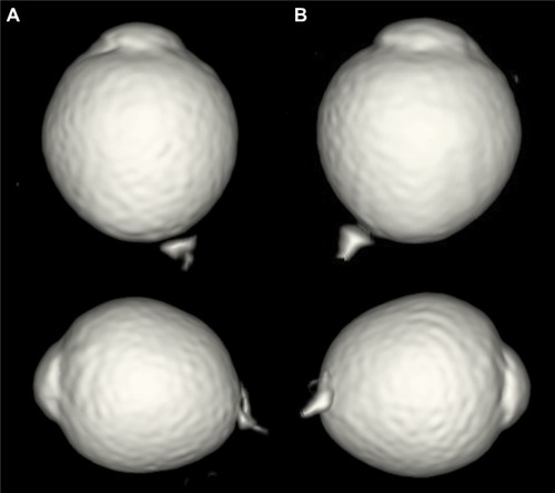 Figure 4 3D MRI images of the right (A) and left (B) eyes.