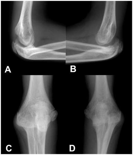 Figure 1. At age 13. Posterior radial head dislocation in both elbows with a bilaterally missing, aplastic ulnar coronoid process. Note the convex posterior contour of the ulna, which is a common finding in cases with congenital dorsal radial head dislocation. There was no humeroulnar dislocation visible on the right side (A, C) and minimal dislocation on the left side (B, D). However, both elbows were stable on clinical examination and the patient did not report any pain or any other symptoms.