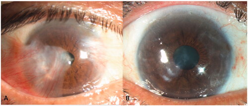 Clinical Photograph 1. Preoperative (A) anterior segment photograph of a patient with a large double-headed pterygium obscuring the visual axis, with unrecordable astigmatism and a best-corrected visual acuity (BCVA) of 6/21. Postoperatively (B), astigmatism improved to −1D and BCVA improved to 6/6.