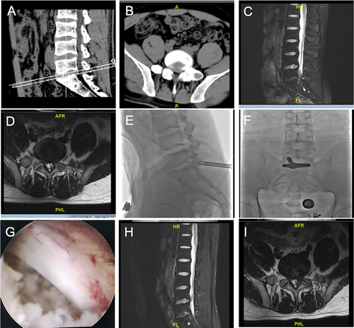 Figure 3 Case two. A 17-year-old male was admitted to our department for severe left low back pain and sciatica of nearly 10 months. The patient was diagnosed with L5/S1 lumbar disc herniation alone (A–D). The soft herniated disc was removed during the PEID surgery (E–G). The patient achieved immediate pain relief and was discharged from hospital within 24 hours. The functional improvement was well at 3 months after PEID (H and I).