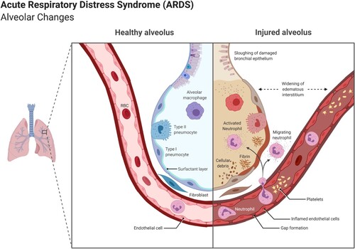 Figure 7. A healthy alveolus (left) and a damaged alveolus (right) in the acute phase of ARDS. An excess of cytokines increases the permeability of the capillaries leading to pulmonary edema (in light brown) that hinders gas exchange in the alveoli, ending in dyspnea and ARDS. (Reprinted from ‘Acute Respiratory Distress Syndrome (ARDS)', by BioRender, July 2020, retrieved from https://app.biorender.com/biorender-templates/ Copyright 2021 by BioRender.)