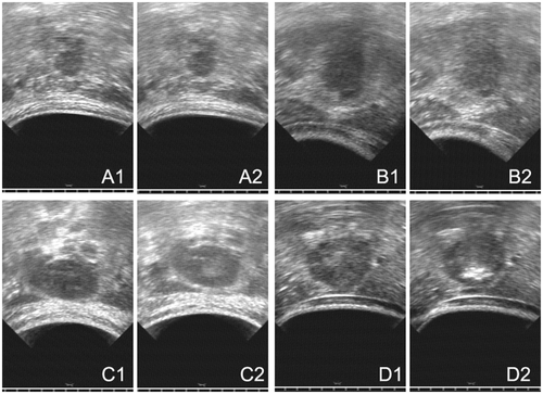 Figure 2. (A) An example of no change, US image obtained before HIFU (A1) and US image obtained after HIFU (A2), Pavg was 183 W and DI was 6.1 kJ/cm3. (B) An example of punctiform change, US image obtained before HIFU (B1) and US image obtained after HIFU (B2), Pavg was 217 W and DI was 8.8 kJ/cm3. (C) An example of lumpish change, US image obtained before HIFU (C1) and US image obtained after HIFU (C2), Pavg was 292 W and DI was 14.6 kJ/cm3. (D) An example of lumpish hyper-echo change, US image obtained before HIFU (D1) and US image obtained after HIFU (D2), Pavg was 275 W and DI was 11.3 kJ/cm3.