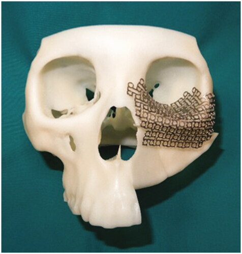 Figure 3. Three-dimensional model of the reconstructed maxilla and titanium mesh was precontoured on the model.