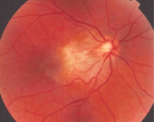 Figure 1 Fundus photograph 18 months before presentation.