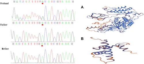 Figure 2 (Left): Chromatogram from Sanger sequencing of the CREBBP variant in the family. (Right): The protein tertiary structure of normal CREBBP protein (A) and mutant CREBBP protein (B) according the SWISS-MODEL analysis.
