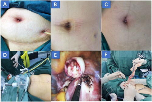Figure 1. (A, B) The condition of the incision after SILS + 1-M operation and drainage tube extraction was improved. (C) Incision condition after LESS-M operation. (D, F) A two-port entry system with a transumbilical single-port technique and an additional 5-mm trocar was used for the extraction of myomas through the transumbilical single-port site. (E) The myoma was removed and the myometrium incision was sutured. SILS + 1-M: single-incision plus one port laparoscopic myomectomy, LESS-M: laparoendoscopic single-site myomectomy.