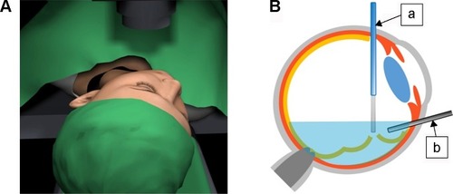 Figure 1 Procedure of ophthalmic endoscope-guided subretinal fluid drainage in pars plana vitrectomy for RRD.
