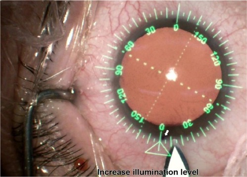 Figure 1 Demonstration of three methods of corneal-limbus position marking: VERION digital marker (green), subjective direct visual marking on the table (bevel knife tip), and horizontal slit beam marking (white arrow, thin blue dot).