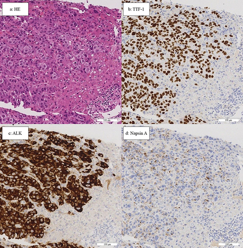 Figure 2 Results of liver biopsy. The scale bars below each image are equivalent to 100μm. (a) Hematoxylin and eosin staining showing atypical cell hyperplasia and formation of glandular luminal structures. (b–d) Immunohistochemical staining of TTF-1, ALK, and Napsin A showing diffuse staining of tumor cells.